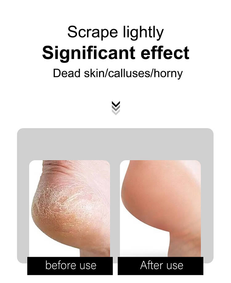 Callus Remover for Home and Spa-9